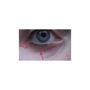 DRS 180 rolleri on silmänympärysalueen mikroneulaustela tarkkuutta vaativaan rollaukseen. Tämä rolleri sopii herkille ja erityistä tarkkuutta vaativille ihoalue